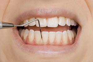 Gingiva