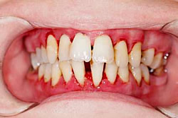 Starke Gingivitis - Entzündung des Zahnfleischs im gesamten Mundbereich