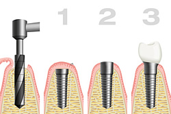 Schematische Darstellung einer Implantation im Kieferknochen. 1.Bohrung, 2.Einheilung, 3.Öffnung, 4.Überkronung