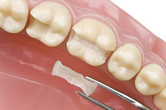 Inlay - Gefertigt mit CEREC aus Keramik 