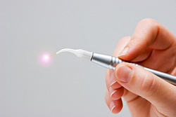 Bei Parodontose hilft schmerzfrei der sanfte Laser vom Zahnarzt
