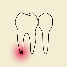 Schematische Darstellung eine Pulpitis - Entzündung des Zahnmarks
