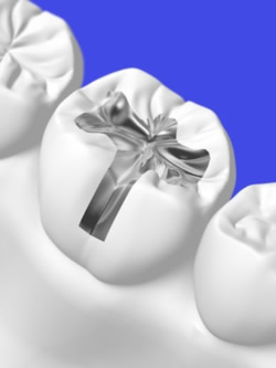 Zahnfüllung in schematischer Darstellung am menschlichen Backenzahn (Molar)