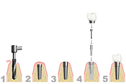 Schematische Darstellung einer Zahnimplantation
